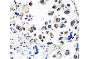 Immunohistochemistry of paraffin-embedded Human lung cancer using CAND1 Polyclonal Antibody at dilution of 1:100 (40x lens). (CAND1 Antikörper)