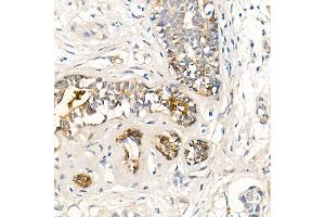 Immunohistochemistry of paraffin-embedded human breast cancer using MMP7 Rabbit mAb (ABIN7268425) at dilution of 1:150 (40x lens). (MMP7 Antikörper)