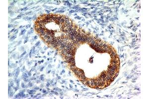Formalin-fixed, paraffin-embedded human Colon Carcinoma stained with E-Cadherin MAb (CDH1/1525).