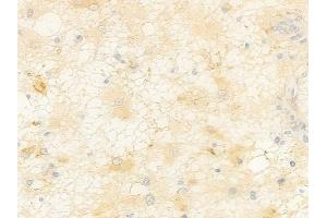 ABIN7096982 and ABIN7101049 at 1/100 staining human astrocytoma by IHC-P.