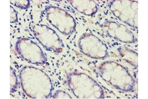 Immunohistochemistry of paraffin-embedded human colon cancer using ABIN7143191 at dilution of 1:100 (ACAD9 Antikörper  (AA 1-270))