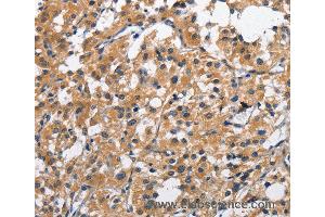Immunohistochemistry of Human liver cancer using CLEC2D Polyclonal Antibody at dilution of 1:70 (CLEC2D Antikörper)