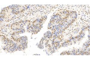 Detection of FOXP3 in Human Colorectal cancer Tissue using Monoclonal Antibody to Forkhead Box P3 (FOXP3) (FOXP3 Antikörper  (AA 191-412))