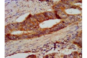 IHC image of ABIN7145452 diluted at 1:300 and staining in paraffin-embedded human colon cancer performed on a Leica BondTM system.