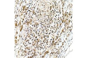 Immunohistochemistry of paraffin-embedded human colon carcinoma using TCF1/TCF7 Rabbit mAb (ABIN7270885) at dilution of 1:100 (40x lens).