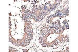 Immunohistochemistry of paraffin-embedded Human colon carcinoma using KRT81 Polyclonal Antibody at dilution of 1:100 (40x lens). (KRT81 Antikörper)