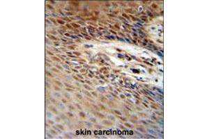ZNF324B antibody immunohistochemistry analysis in formalin fixed and paraffin embedded human skin carcinoma followed by peroxidase conjugation of the secondary antibody and DAB staining. (ZNF324B Antikörper  (C-Term))