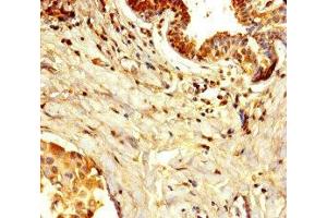 Immunohistochemistry of paraffin-embedded human breast cancer using ABIN7150005 at dilution of 1:100 (Diphthamide Biosynthesis 7 (DPH7) (AA 210-325) Antikörper)