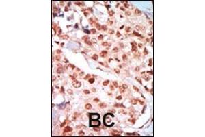 Formalin-fixed and paraffin-embedded human cancer tissue reacted with the primary antibody, which was peroxidase-conjugated to the secondary antibody, followed by DAB staining. (PRKAA2 Antikörper  (AA 265-295))