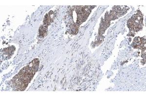 IHC-P Image Immunohistochemical analysis of paraffin-embedded human ovarian cancer, using GLO1, antibody at 1:100 dilution. (GLO1 Antikörper)