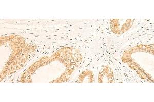 Immunohistochemistry of paraffin-embedded Human breast cancer tissue using IFI35 Polyclonal Antibody at dilution of 1:35(x200) (IFI35 Antikörper)
