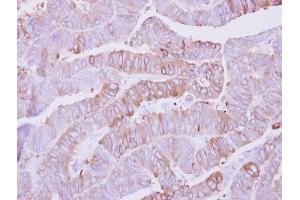 IHC-P Image Immunohistochemical analysis of paraffin-embedded human colon carcinoma, using Casein Kinase 1 alpha 1L, antibody at 1:500 dilution. (CSNK1A1L Antikörper)