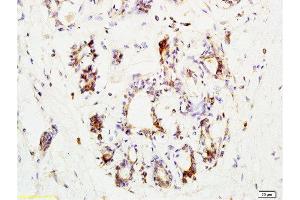 Formalin-fixed and paraffin embedded human breast carcinoma labeled with Anti-CCR3 Polyclonal Antibody, Unconjugated  at 1:200 followed by conjugation to the secondary antibody and DAB staining.