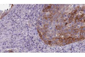 ABIN6275176 at 1/100 staining Human urothelial cancer tissue by IHC-P. (GNAL Antikörper  (Internal Region))