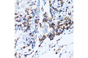 Immunohistochemistry of paraffin-embedded human lung cancer using SPN antibody (ABIN5973813) at dilution of 1/100 (40x lens).