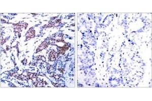 Immunohistochemistry analysis of paraffin-embedded human breast carcinoma, using c-Jun (Phospho-Ser73) Antibody. (C-JUN Antikörper  (AA 40-89))