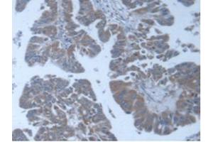 IHC-P analysis of Human Liver Cancer Tissue, with DAB staining. (POFUT1 Antikörper  (AA 238-388))