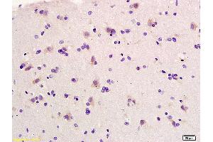 Formalin-fixed and paraffin embedded human glioma labeled with Anti-Elastin Polyclonal Antibody, Unconjugated (ABIN734003) at 1:200 followed by conjugation to the secondary antibody and DAB staining.