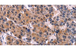 Immunohistochemistry of paraffin-embedded Human liver cancer tissue using EIF2AK4 Polyclonal Antibody at dilution 1:50 (GCN2 Antikörper)