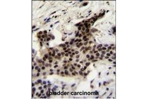 UBXN2A Antibody (C-term) (ABIN655308 and ABIN2844890) immunohistochemistry analysis in formalin fixed and paraffin embedded human bladder carcinoma followed by peroxidase conjugation of the secondary antibody and DAB staining. (UBXN2A Antikörper  (C-Term))