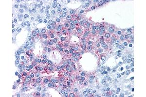 Anti-GPRC6A antibody IHC of human Prostate, Carcinoma. (GPRC6A Antikörper  (N-Term))