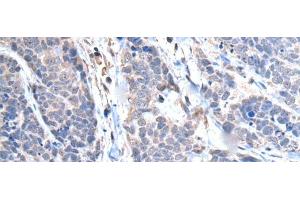 Immunohistochemistry of paraffin-embedded Human thyroid cancer tissue using TRIM27 Polyclonal Antibody at dilution of 1:65(x200) (TRIM27 Antikörper)