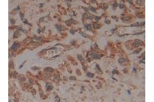 Detection of FADD in Human Lung cancer Tissue using Polyclonal Antibody to Fas Associating Death Domain Containing Protein (FADD) (FADD Antikörper  (AA 12-206))