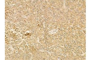 ABIN6263787 and ABIN6278498 at 1/100 staining human hepatocellular carcinoma by IHC-P. (SLC22A6 Antikörper  (Internal Region))