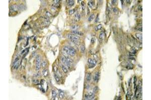 Immunohistochemistry analysis of TNF-alpha Antibody in paraffin-embedded human colon carcinoma tissue. (TNF alpha Antikörper)