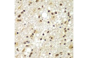 Immunohistochemistry of paraffin-embedded human brain cancer using ZNF20 antibody at dilution of 1:100 (x400 lens). (ZNF20 Antikörper)