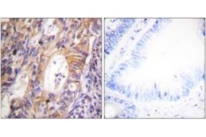 Immunohistochemistry analysis of paraffin-embedded human colon carcinoma, using c-Met (Phospho-Tyr1003) Antibody. (c-MET Antikörper  (pTyr1003))