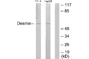 Immunohistochemistry analysis of paraffin-embedded human colon carcinoma tissue using Desmin (Ab-60) antibody. (Desmin Antikörper)