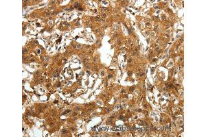 Immunohistochemistry of Human lung cancer using AMD1 Polyclonal Antibody at dilution of 1:30 (AMD1 Antikörper)