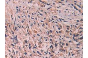 DAB staining on IHC-P;;Samples: Human Prostate cancer Tissue (IL-24 Antikörper  (AA 51-206))