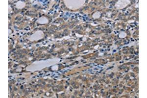 The image on the left is immunohistochemistry of paraffin-embedded Human thyroid cancer tissue using ABIN7191523(MT-ND3 Antibody) at dilution 1/30, on the right is treated with synthetic peptide. (MT-ND3 Antikörper)