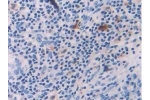 DAB staining on IHC-P; Samples: Human Skin cancer Tissue (IL-18 Antikörper  (AA 37-193))