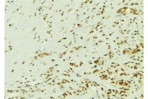 ABIN6269139 at 1/100 staining Human breast cancer tissue by IHC-P.
