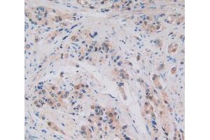 Used in DAB staining on fromalin fixed paraffin- embedded prostate gland cancer tissue (ALOX15B Antikörper  (AA 253-490))