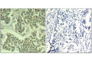 Immunohistochemical analysis of paraffin-embedded human breast carcinoma tissue using eIF2α (Phospho-Ser49) Antibody (left) or the same antibody preincubated with blocking peptide (right). (EIF2S1 Antikörper  (pSer49))