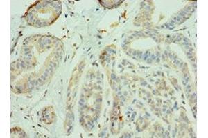 Immunohistochemistry of paraffin-embedded human breast cancer using ABIN7156335 at dilution of 1:100 (IRS1 Antikörper  (AA 1-160))