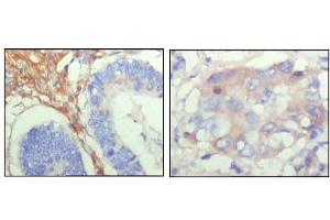 Immunohistochemical analysis of paraffin-embedded human colon cancer (left) and breast cancer (right) showing cytoplasmic localization with DAB staining using FBLN5 mouse mAb. (Fibulin 5 Antikörper)