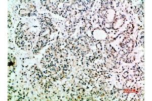 Immunohistochemical analysis of paraffin-embedded human-stomach-cancer, antibody was diluted at 1:200. (EGF Antikörper  (AA 1000-1060))