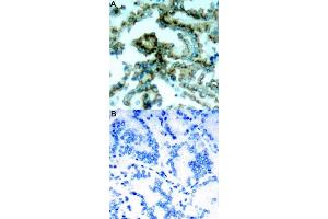 Immunohistochemical staining of human lung cancer tissue by PRKCB (phospho T641) polyclonal antibody  without blocking peptide (A) or preincubated with blocking peptide (B) under 1:50-1:100 dilution.