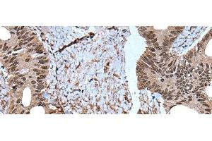 Immunohistochemistry of paraffin-embedded Human colorectal cancer tissue using ZNF787 Polyclonal Antibody at dilution of 1:45(x200) (ZNF787 Antikörper)