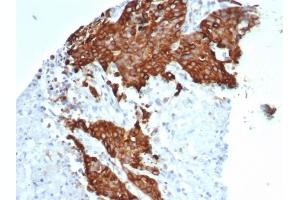 Formalin-fixed, paraffin-embedded human ovarian carcinoma stained with Tubulin beta 3 Recombinant Rabbit Monoclonal Antibody (TUBB3/7089R). (Rekombinanter TUBB3 Antikörper  (AA 437-450))