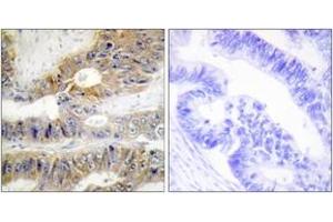 Immunohistochemistry analysis of paraffin-embedded human colon carcinoma tissue, using TNFRSF6B Antibody. (TNFRSF6B Antikörper  (AA 251-300))