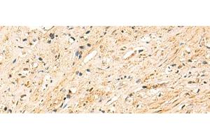 Immunohistochemistry of paraffin-embedded Human prost at e cancer tissue using EEF1AKMT2 Polyclonal Antibody at dilution of 1:50(x200) (METTL10 Antikörper)