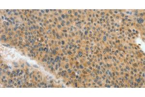 Immunohistochemistry of paraffin-embedded Human liver cancer tissue using ACLY Polyclonal Antibody at dilution 1:40 (ACLY Antikörper)