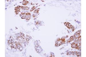 IHC-P Image Immunohistochemical analysis of paraffin-embedded human lung adenocarcinoma, using MASPIN, antibody at 1:100 dilution. (SERPINB5 Antikörper  (Center))