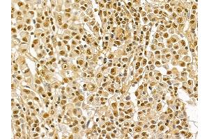 NRF1 Mouse Monoclonal Antibody at 1/100 staining human gastric cancer by IHC-P. (NRF1 Antikörper  (Internal Region))